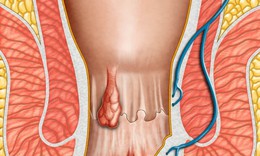 C&#225;ch chữa bệnh trĩ tại nh&#224; hiệu quả