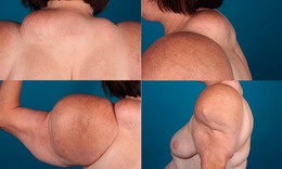 Câu hỏi thường gặp liên quan đến loạn dưỡng mỡ