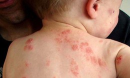 Các loại chàm thường gặp và đối tượng dễ mắc