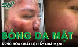 Bỏng da do d&#249;ng h&#243;a chất lột tẩy qu&#225; mạnh