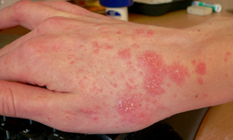 Mùa mưa lũ cảnh giác với bệnh ghẻ và cách nhận biết sớm