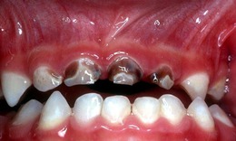 Hội chứng s&#226;u răng do b&#250; b&#236;nh 