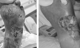 Người đàn ông suýt phải cắt cụt chân vì đái tháo đường