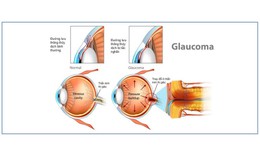 Biểu hiện sớm của bệnh gl&#244;c&#244;m