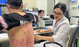 C&#225;ch ngăn chặn &#39;hiệu ứng Domino&#39; ở bệnh nh&#226;n vảy nến