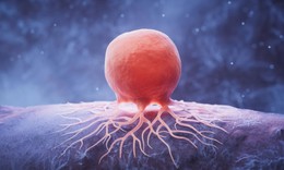 Giảm chất b&#233;o c&#243; thể &#39;bỏ đ&#243;i&#39; tế b&#224;o ung thư v&#250;