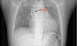 Vừa xem tivi vừa chơi, b&#233; 13 tuổi nuốt đinh ghim v&#224;o đường thở