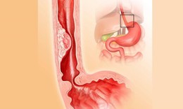 Ợ nóng, đau ngực cảnh báo viêm thực quản
