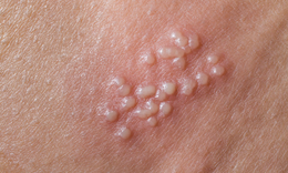 Nguy&#234;n&#160;nh&#226;n&#160;g&#226;y&#160;bệnh&#160;mụn&#160;rộp&#160;sinh&#160;dục