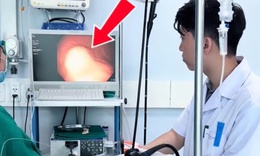 Đi kh&#225;m v&#236; ho, người đ&#224;n &#244;ng ph&#225;t hiện u m&#244; đệm dạ d&#224;y nguy hiểm