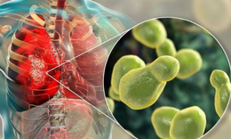 Những bệnh l&#253; tại phổi n&#224;o thường gặp ở người nhiễm HIV?