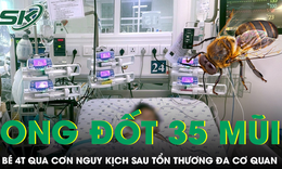 Bé trai 4 tuổi bị ong vò vẽ đốt 35 mũi qua cơn nguy kịch sau 3 tuần điều trị
