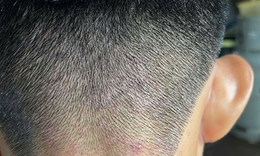 Hiểu đ&#250;ng về g&#224;u v&#224; nấm da đầu – V&#236; sao c&#224;ng d&#249;ng &#39;mẹo&#39; d&#226;n gian c&#224;ng nặng?