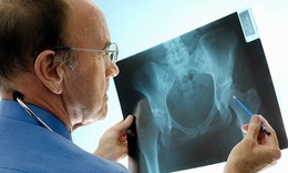 4 loại thực phẩm &#226;m thầm l&#224;m tăng nguy cơ lo&#227;ng xương