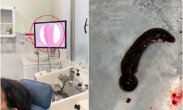 H&#227;i h&#249;ng con đỉa 6cm sống trong mũi cụ b&#224; suốt 3 tuần