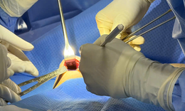 Th&#225;o t&#250;i ngực v&#224; thay t&#250;i ngực: Phương ph&#225;p g&#226;y m&#234;, kỹ thuật phẫu t&#237;ch, hồi phục