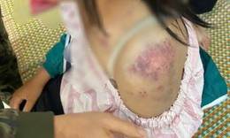 Những vết thương chi ch&#237;t tr&#234;n cơ thể của c&#244; b&#233; bị bạo h&#224;nh