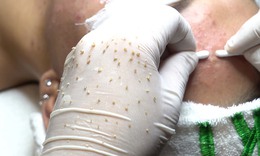 Nỗi đau kh&#244;ng thể ngờ sau khi nhiễm H từ một lần l&#224;m đẹp tại spa