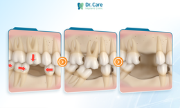 C&#243; n&#234;n trồng răng số 6 (răng cấm) khi mất răng, chi ph&#237; c&#243; đ&#225;ng với chất lượng?