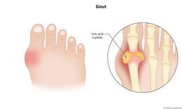 Thiếu vitamin D c&#243; thể g&#226;y tăng axit uric