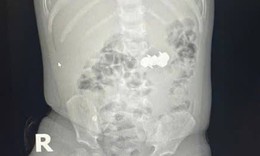 B&#233; trai nuốt 4 vi&#234;n đinh nam ch&#226;m đầu nhọn nguy hiểm
