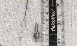 Ho k&#233;o d&#224;i sau khi l&#224;m răng, người đ&#224;n &#244;ng ph&#225;t hiện dụng cụ nha khoa trong phế quản