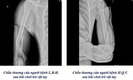 Cảnh b&#225;o nguy cơ gẫy xương c&#225;nh tay từ tr&#242; vật tay