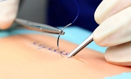 Đột phá phẫu thuật an toàn nhờ nút thắt 'lập trình sẵn'