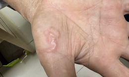 Biểu hiện mắc giun s&#225;n cần đi kh&#225;m sớm, kh&#225;m ở đ&#226;u?