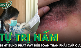 Mẹ tự mua thuốc trị nấm cho con, b&#233; g&#225;i 6 tuổi b&#249;ng ph&#225;t vảy nến to&#224;n th&#226;n phải cấp cứu khẩn