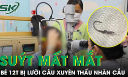 B&#233; trai 12 tuổi su&#253;t mất mắt v&#236; lưỡi c&#226;u c&#225; xuy&#234;n thấu nh&#227;n cầu