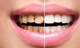 Lợi &#237;ch khi lấy cao răng, khi n&#224;o kh&#244;ng n&#234;n lấy cao răng?