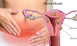 Dấu hiệu điển h&#236;nh của u xơ tử cung