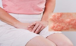 C&#244; g&#225;i mắc s&#249;i m&#224;o g&#224; sau nhiều lần quan hệ với bạn trai