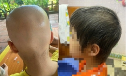 B&#233; g&#225;i 7 tuổi rụng hết t&#243;c bất ngờ mọc k&#237;n đầu sau một năm