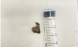 Ho khan nhiều th&#225;ng, người đ&#224;n &#244;ng bất ngờ được ph&#225;t hiện dị vật mắc s&#226;u trong đường thở