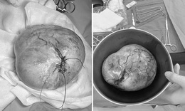 Phenikaa phẫu thuật th&#224;nh c&#244;ng cho b&#233; g&#225;i 9 tuổi mắc u qu&#225;i buồng trứng 20 cm, bảo to&#224;n khả năng sinh sản