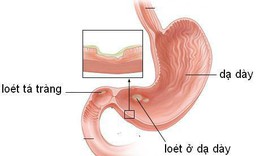 5 biến chứng thường gặp của ung thư dạ dày cần biết
