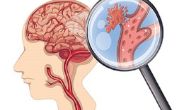 Các dấu hiệu đột quỵ dễ bị bỏ qua khi trời lạnh