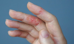 6 lưu ý quan trọng cho người bị viêm da cơ địa khi thời tiết khô hanh