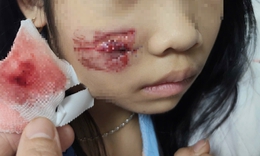 Ch&#225;u b&#233; bị khỉ tấn c&#244;ng g&#226;y vết thương phức tạp v&#249;ng mặt, đầu