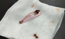 Bé 6 tuổi nhập viện cấp cứu vì nuốt kẹp tóc kim loại