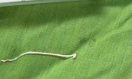 Phẫu thuật khối u, phát hiện ký sinh trùng dạng sán trong vùng hố chậu bệnh nhân