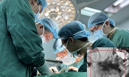 Nối thành công 4 ngón tay gần đứt rời cho bệnh nhân 25 tuổi