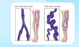 Thuốc và phương pháp điều trị suy tĩnh mạch chi dưới mạn tính