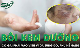 Mua hũ kem ‘xịn’ theo lời bạn b&#232;, c&#244; g&#225;i phải v&#224;o viện v&#236; da sưng đỏ, ph&#249; nề nặng