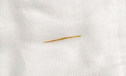 Thủng ruột do thói quen rất nhiều người mắc