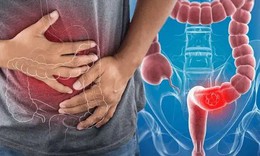 Ung thư đại trực tràng cần theo dõi sau điều trị như thế nào?