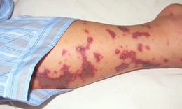 Số ca mắc bệnh do não mô cầu tăng, chuyên gia y tế khuyến cáo gì đến cộng đồng?