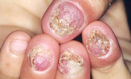 Điều trị hiệu quả nấm móng tay, móng chân